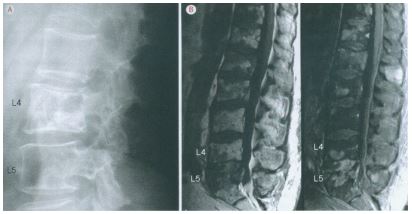 Radiografia e Ressonância da Coluna Vertebral